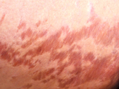 striae als bijwerking van lokale corticosteroiden