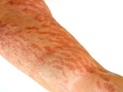 Stretch marks as a side effect of systemic corticosteroids (click on photo to enlarge) [source: www.huidziekten.nl]