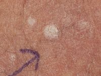 Stuccokeratosis