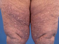 Stuccokeratosis