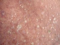 Stuccokeratosis
