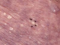 Stuccokeratosis