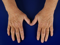 Stuccokeratosis