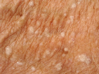 Stuccokeratosis