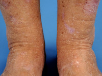 Stuccokeratosis