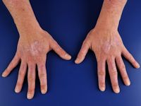 Subacute cutane lupus erythematosus (SCLE)