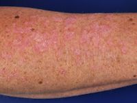 Subacute cutane lupus erythematosus (SCLE)