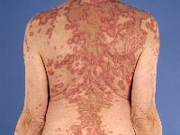 Subacute cutaneous lupus erythematosus (SCLE)