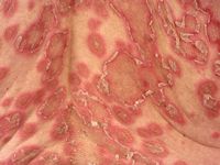 Subacute cutaneous lupus erythematosus (SCLE)