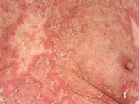 Subacute cutaneous lupus erythematosus (SCLE)