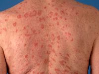 Subacute cutaneous lupus erythematosus (SCLE)