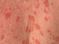 Subacute cutaneous lupus erythematosus (SCLE)
