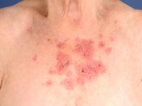 Subacute cutaneous lupus erythematosus (SCLE)
