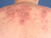 Subacute cutaneous lupus erythematosus (SCLE)