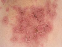 Subacute cutaneous lupus erythematosus (SCLE)