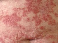 Subacute cutane lupus erythematosus (SCLE)