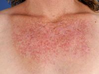 Subacute cutaneous lupus erythematosus (SCLE)