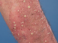 Ziekte van Sneddon-Wilkinson (subcorneal pustular dermatosisis)