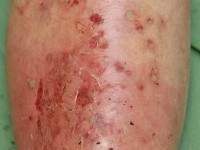 Ziekte van Sneddon-Wilkinson (subcorneal pustular dermatosisis)