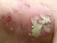 Ziekte van Sneddon-Wilkinson (subcorneal pustular dermatosisis)