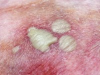 Ziekte van Sneddon-Wilkinson (subcorneal pustular dermatosisis)