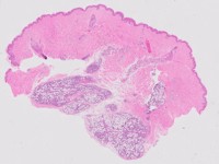 PA subcutaneous panniculitis-like T-cell lymphoma
