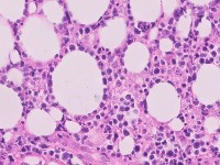 PA subcutaneous panniculitis-like T-cell lymphoma