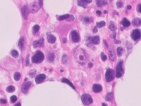 PA subcutaneous panniculitis-like T-cell lymphoma