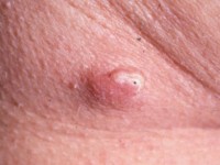 Subepidermal calcified nodule