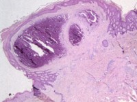 Subepidermal calcified nodule