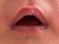 Zuigblaren (suction blisters)