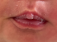 Zuigblaren (suction blisters)