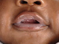 Zuigblaren (suction blisters)