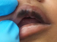 Zuigblaren (suction blisters)