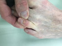 Superficial acral fibromyxoma