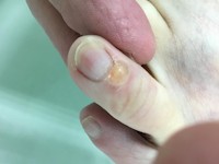 Superficial acral fibromyxoma