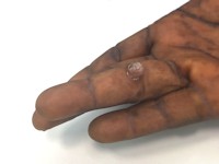 Superficial acral fibromyxoma