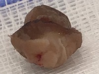 Superficial acral fibromyxoma