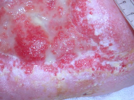 Transplantatie ulcus met keratinocyten suspensie