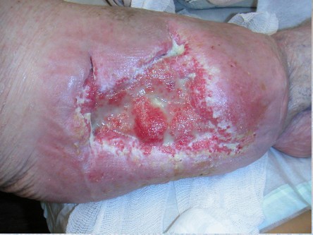 Transplantatie ulcus met keratinocyten suspensie