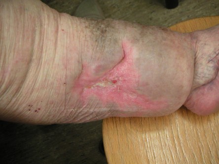 Transplantatie ulcus met keratinocyten suspensie