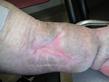 Transplantatie ulcus met keratinocyten suspensie