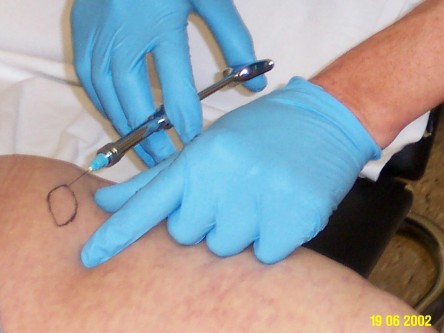 Transplantatie ulcus met keratinocyten suspensie