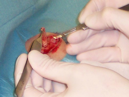 Transplantatie ulcus met keratinocyten suspensie