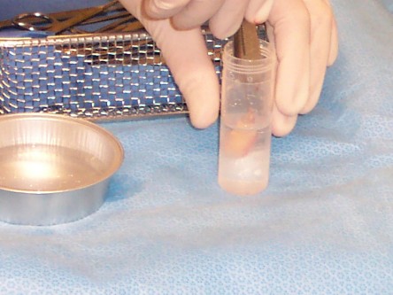 Transplantatie ulcus met keratinocyten suspensie