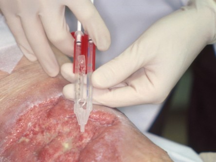 Transplantatie ulcus met keratinocyten suspensie