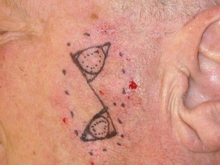 Burow advancement flap