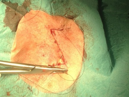 Burow advancement flap