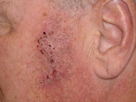 Burow advancement flap