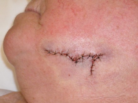 Burow advancement flap